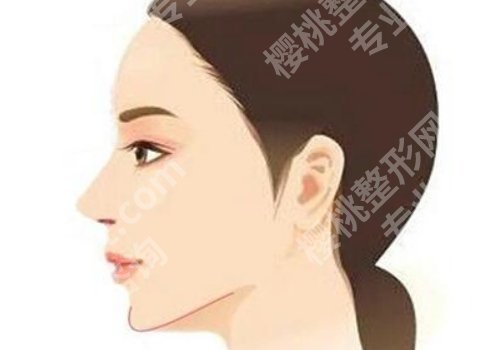 刘育凤医生做颏成型怎么样？详细介绍及顾客点评揭晓