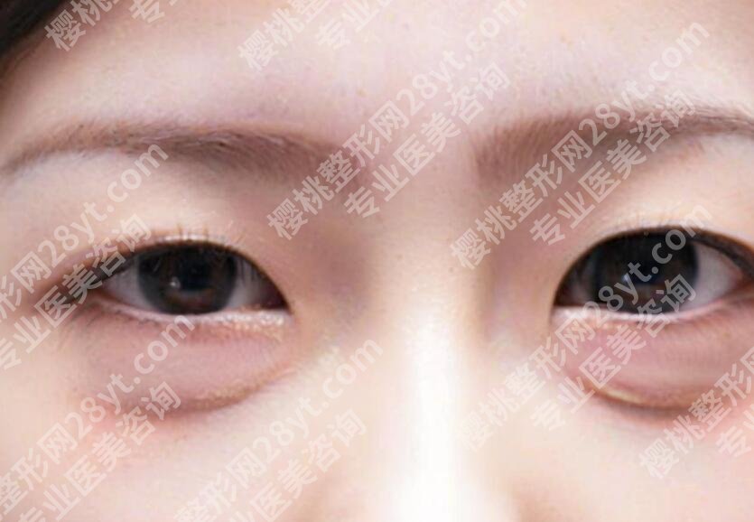 上海九院许志成去眼袋怎么样?医生信息|案例点评!