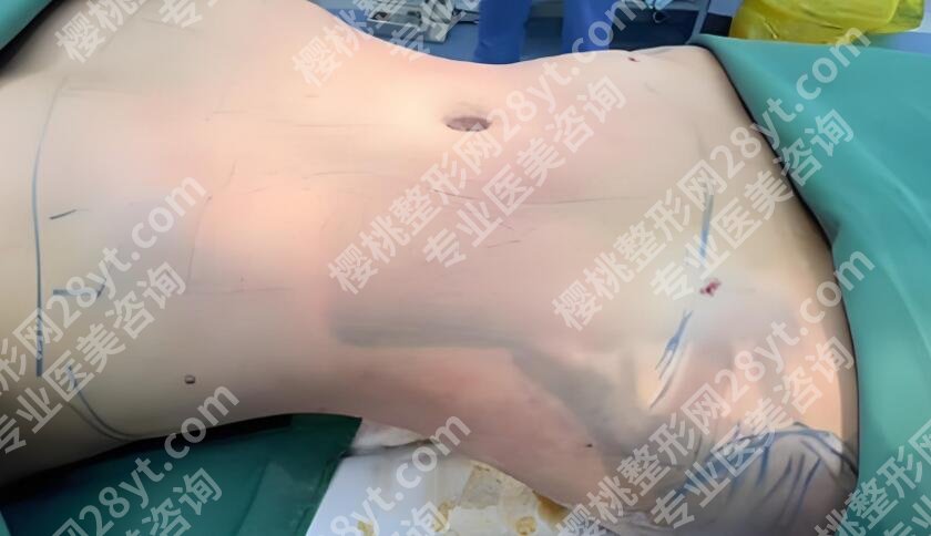 重庆腹壁整形术多少钱啊?收费表更新+医院名单一览!