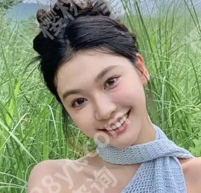 广州王世虎脂肪填充怎么样?医院做填充技术优势分析!附案例