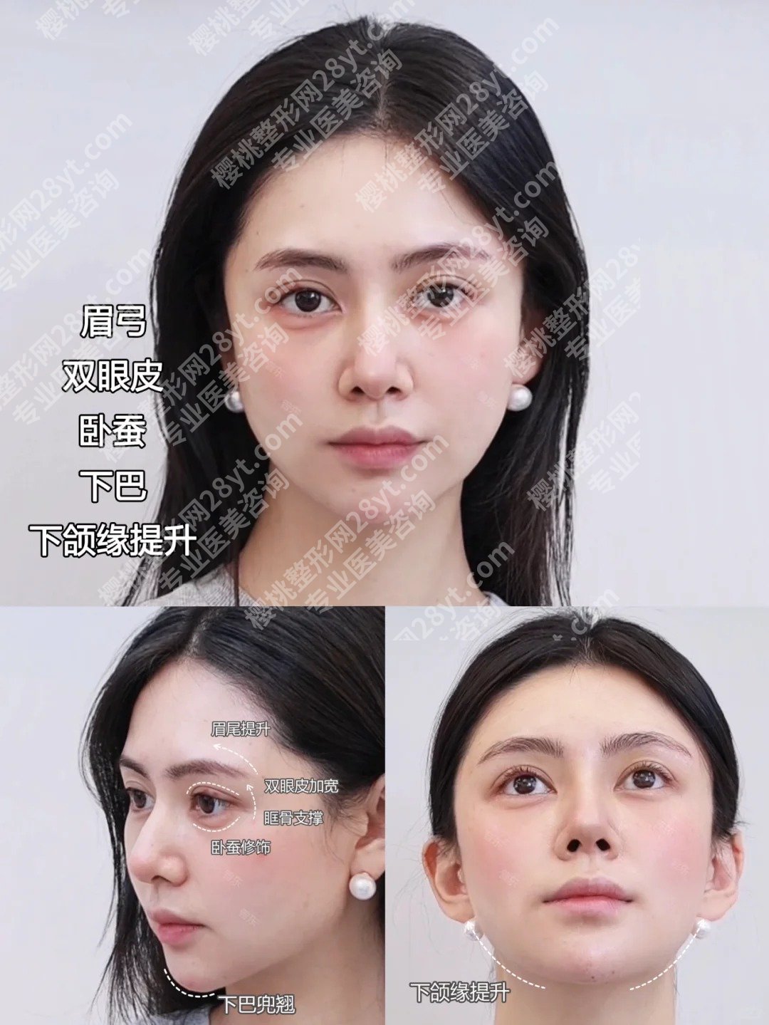 北京加减美面部提升贵吗?医院简介|真实案例图展示!