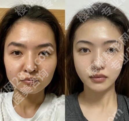 北京加减美美容v6价格贵吗？王正刚、叶怀挺谁的技术好？