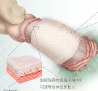 生物补片增粗能维持多长时间？优势及注意事项分享！