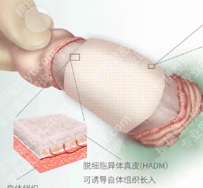 生物补片增粗能维持多长时间？优势及注意事项分享！