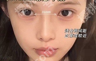 焦虎医生做双眼皮怎么样？坐诊医院及真实的顾客点评来袭！