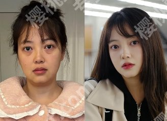 南京友谊整形医院做眼袋好吗？人气医生及真实的口碑点评来袭！