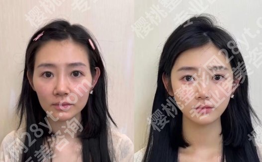 连云港面部吸脂医院哪家好？做面吸项目避坑指南来袭！