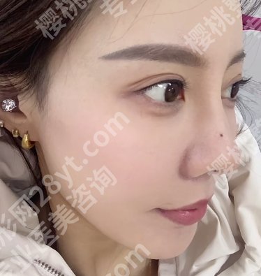 广州南方医院点阵激光怎么样？胡志奇医生做的好吗？附案例