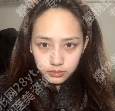 宁大附属医院去眼袋要多少钱？出进来看当地网友的真实点评！