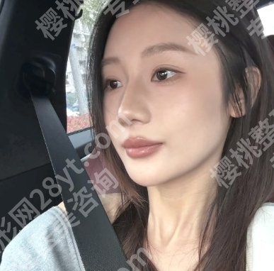 武汉五洲医疗美容隆鼻价格贵不贵？杨水斌实操鼻部项目案例分享！