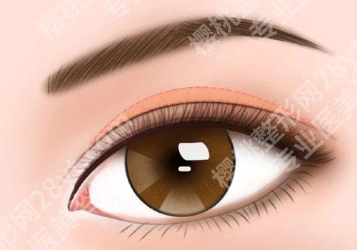成都傅荣双眼皮做的好吗？医生技术、口碑点评一览