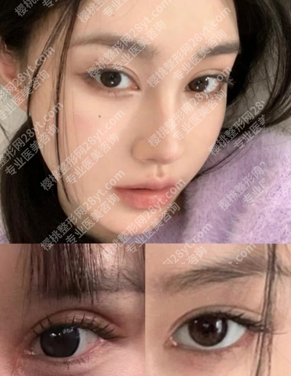 北京黄久佐修复双眼皮什么价位？技术怎么样？风格自然吗？