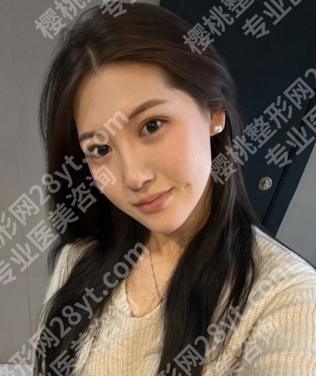 吕薇医生双眼皮怎么样？技术点评、口碑点评、价格参考