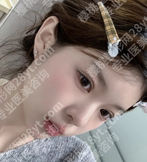 苏永胜医生做埋线双眼皮吗？基本信息及真实案例反馈