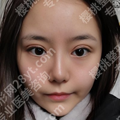 成都卢尚兵修复双眼皮怎么样？医生资料、真实案例分享！