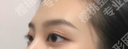 扬州艾菲斯割双眼皮怎么样？戳进来看真人眼部案例图