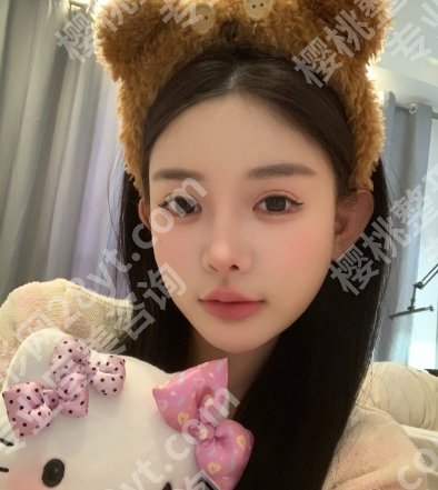 扬州艾菲斯割双眼皮怎么样？戳进来看真人眼部案例图