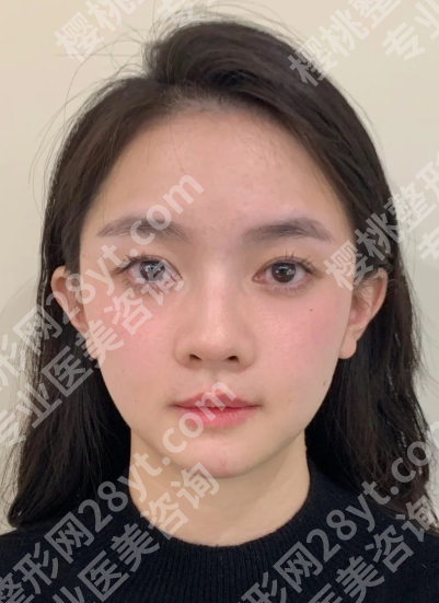 北京谢洋春拉皮案例更新！预约面诊流程、案例效果、面诊攻略