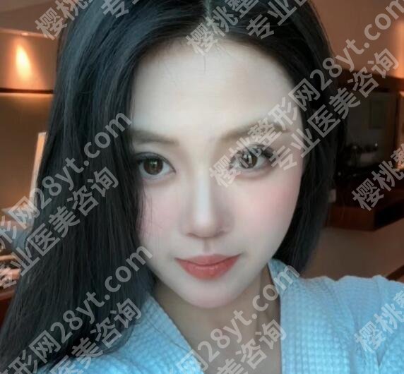 上海孙笛医生怎么样？做双眼皮自然吗？真实案例图评价~