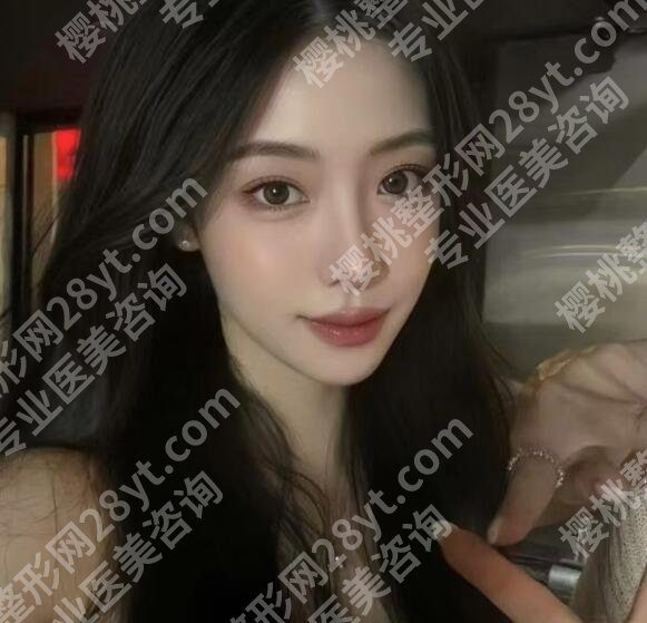 济南薛峰双眼皮价格贵不贵？技术靠谱吗？网友亲身经历分享！