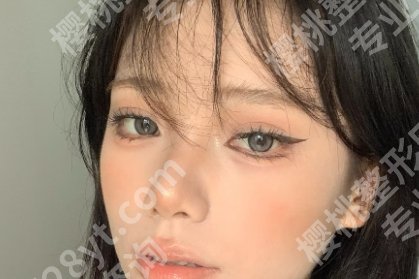 扬州雷医生整形开眼角怎么样？内附*新价格表一览！真实案例图片分享！