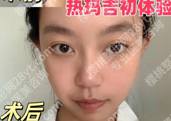 合肥热玛吉多少钱？2025价格一览+授权医院top榜分享！