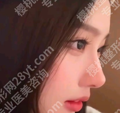 姜鑫利做鼻子怎么样？真人案例分享！来看价格表
