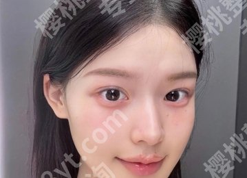 福州面部脂肪填充好的医生推荐！选择医院和医生tips分享！