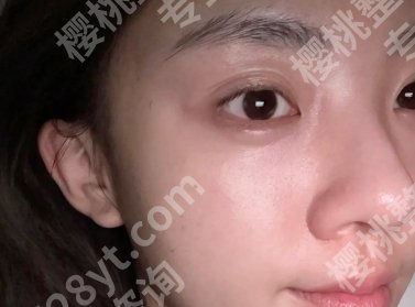 珠海拉皮手术费多少钱？2025价格一览+靠谱医生排名分享！