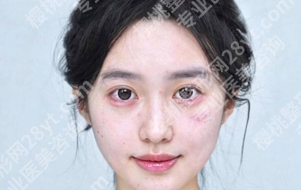 广州拉皮医生袁强技术好不好？经典案例|见证TA的蜕变
