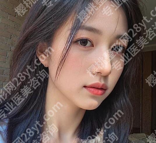 宫风勇医生做鼻子太自然了！自然又不失精致的美鼻结果附上！