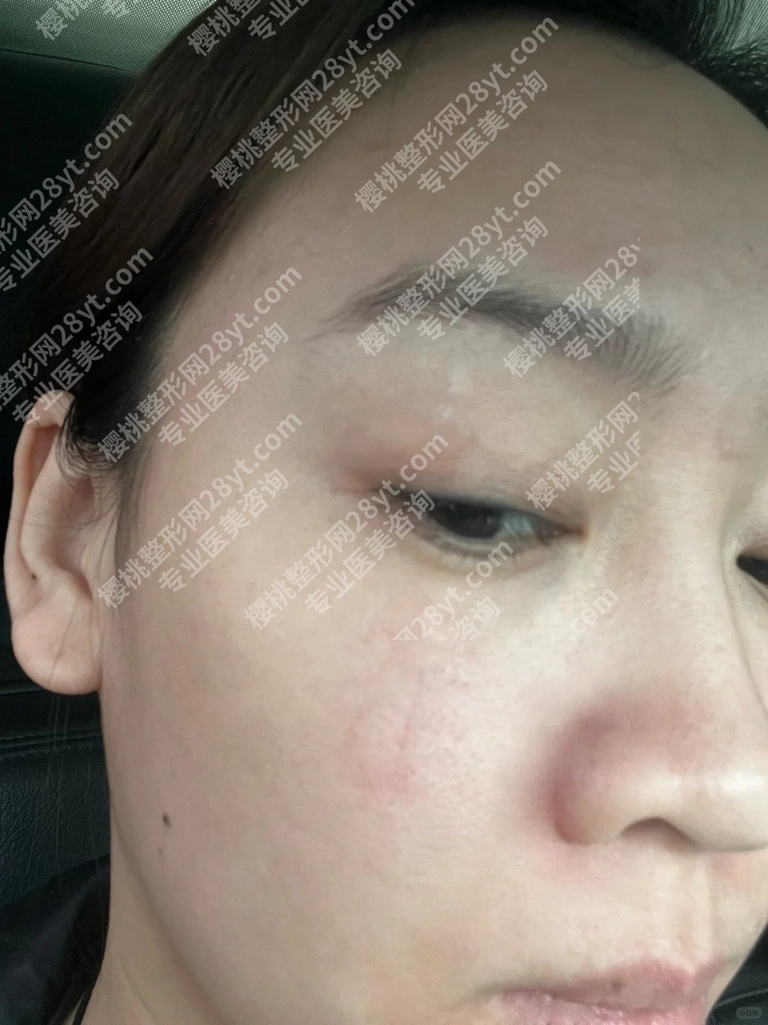 深圳鹏程医院疤痕怎么样？明星项目和案例反馈