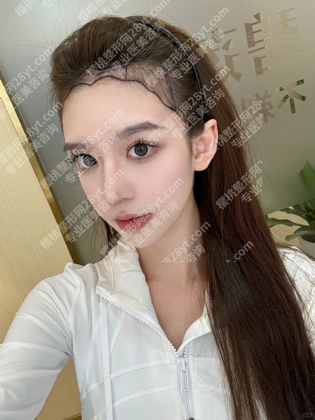 陈露露医生植发!明星项目和坐诊医院介绍