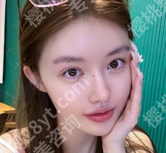 上海六院割双眼皮费用贵不贵？戳进来看院内真人案例吧