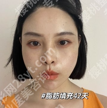 重庆哪里做脂肪填充好？各医院代表医生推荐给大家！