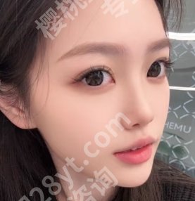 杨明强医生个人简历分享!戳进来看真人眼部手术案例图