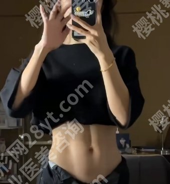 郑京桓医生做吸脂怎么样？戳进来看真人案例吧