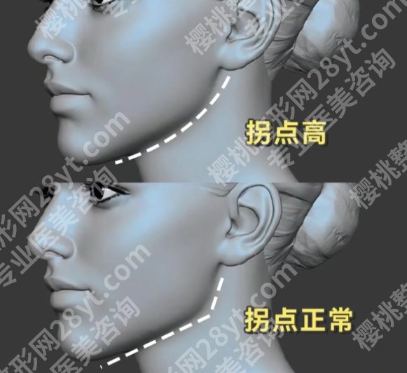 邱立东做什么厉害？下颌角整形手术前后小贴士分享！