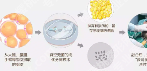 李发成自体脂肪丰胸价格是多少？分享价格明细和医生资料查看