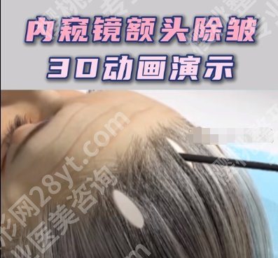 谢宏彬内窥镜手术费价格贵不贵？做除皱提眉项目面诊小技巧get！