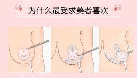 北京八大处胸部缩小术怎么样？医院简介|真人效果图展示！