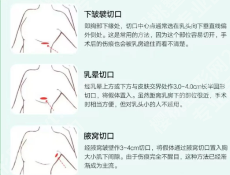 广东美恩整形美容医院隆胸价格是多少？了解费用标准，预约方式查看