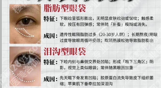 吴慧玲医生去眼袋图片怎么样？挑选医生的小经验分享