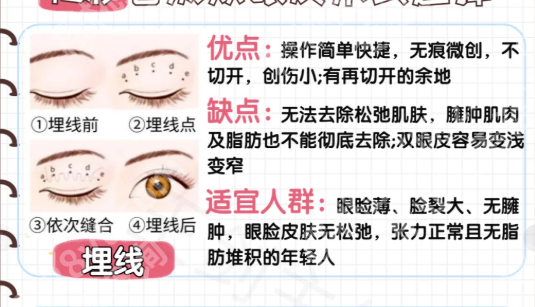 北京谭章梅双眼皮修复案例怎么样？含详细案例过程分享