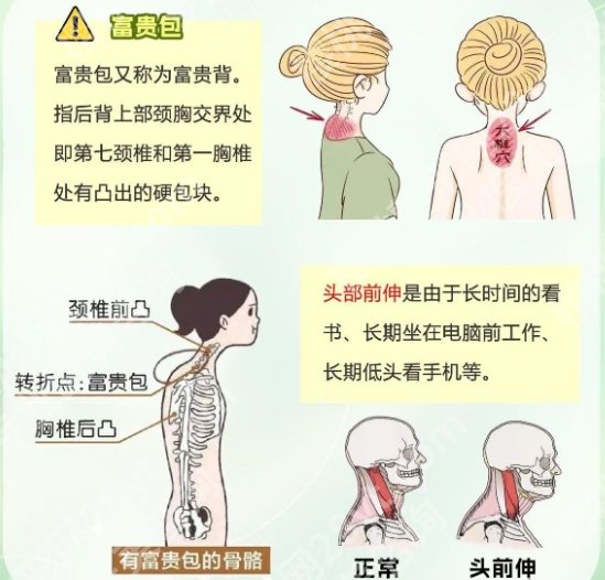 浙江大学医学院附属第一医院整形外科富贵包看什么科室？就诊必看！
