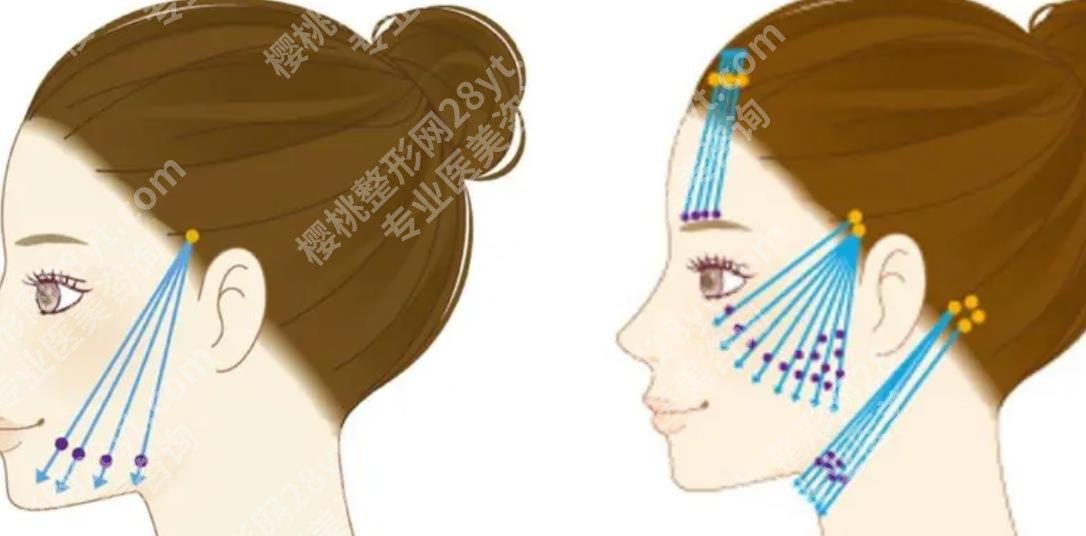 北京杨大平的面部提升切口位置在哪里？抗衰项目大科普