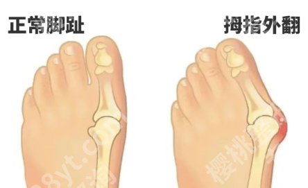 苏敬达做拇外翻什么价格？2025全新收费标准更新！