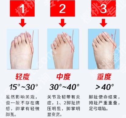 苏敬达做拇外翻什么价格？2025全新收费标准更新！