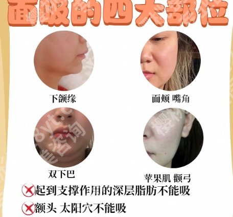泰州面部吸脂医院名单汇总！来看看有没有你心仪的医院！