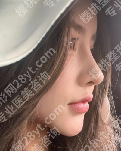 北京刘暾做鼻子怎么样？详附诉求方案、面诊攻略细致讲解